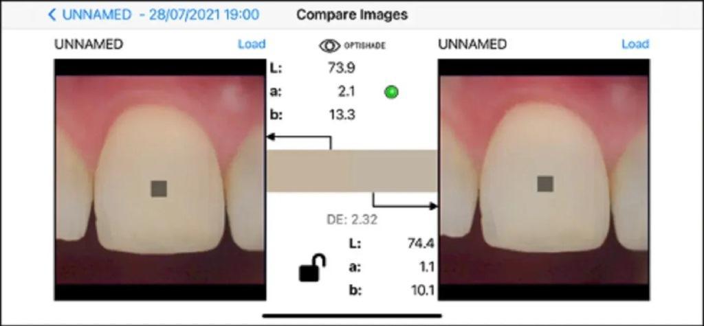 Digital determination of tooth shades : practical application of modern 16