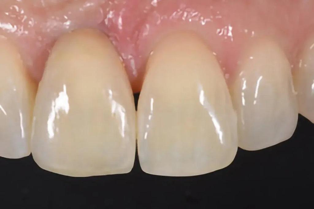 Digital determination of tooth shades : practical application of modern 20