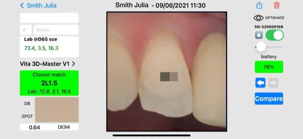 Digital determination of tooth shades : practical application of a modern 22