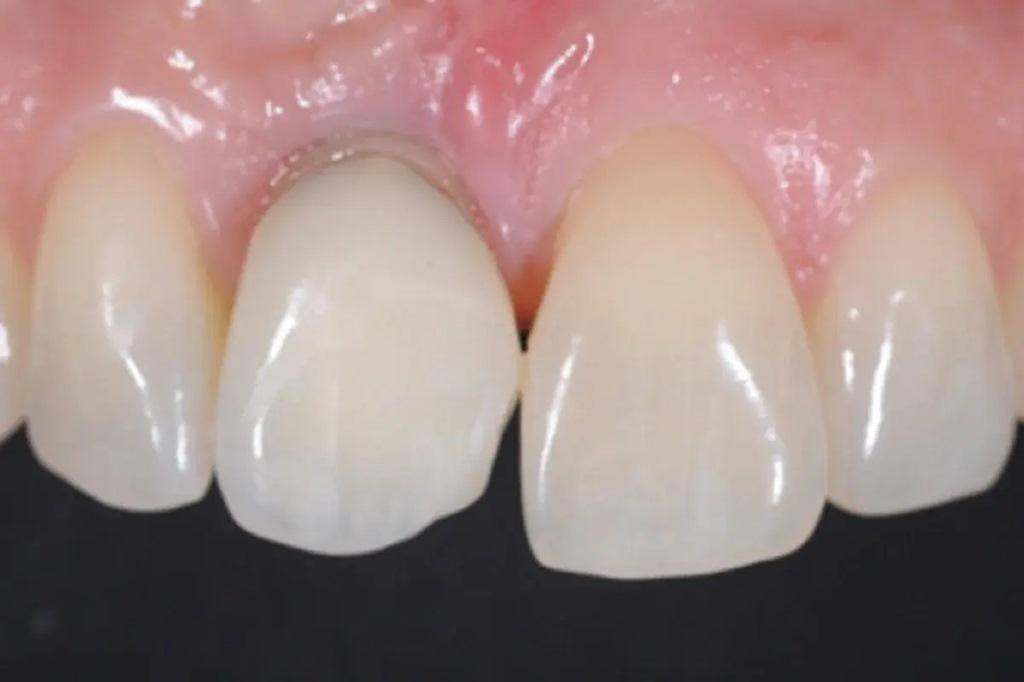 Digital determination of tooth shades: practical application of modern colorimeter19