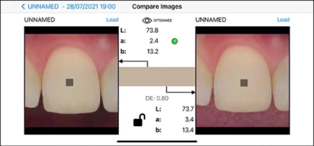 Digital determination of tooth shades : practical application of modern 15