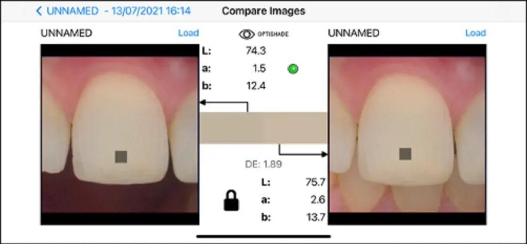 Digital determination of tooth shades : practical application of modern 14