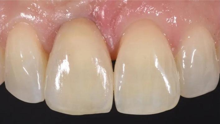 Digital determination of teeth shades : practical application of modern colorimeter