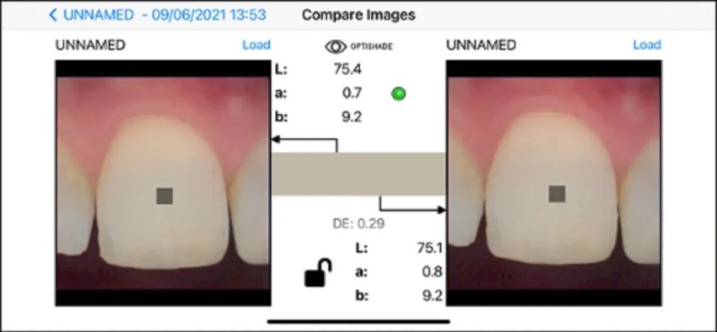 Digital determination of teeth shades : practical application of modern 12