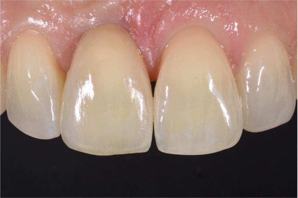 Digital determination of tooth shades : practical application of modern 25