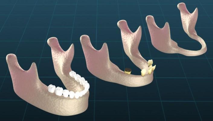 Can antihypertensive drugs to prevent jaw bone loss?