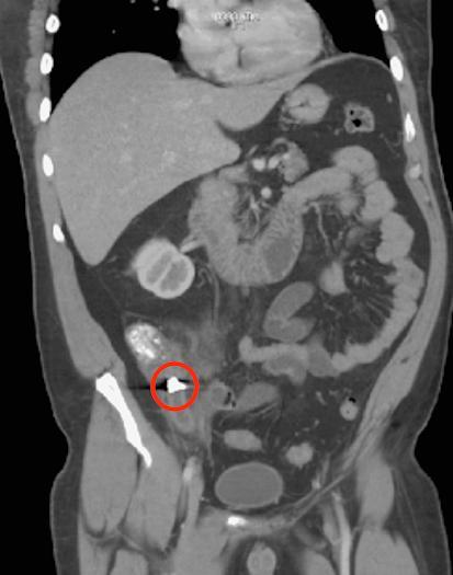 A man swallowed a dental crown, which led to the development appendicitis1