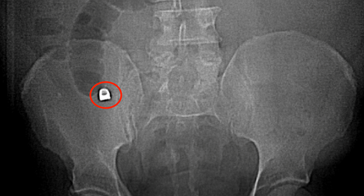 Man swallowed crown, leading to appendicitis