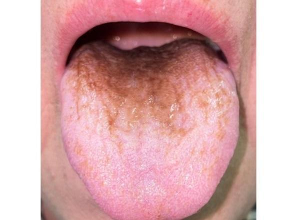  After taking antibiotics, a woman developed black hairy tongue syndrome