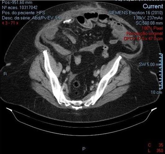 Visualization helped to remove the tooth prosthesis from the intestines of a woman1