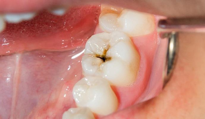 Selenium dental sealants can help prevent caries