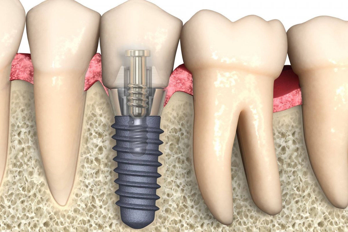 What is All-on-6 dental implantation, the history of the method, its advantages and in what cases is it used?