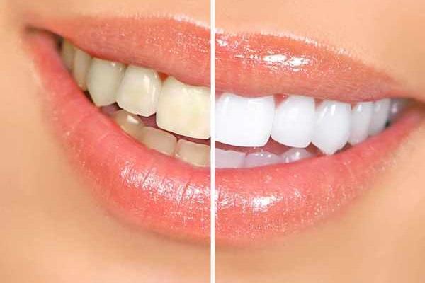 The use of nanoparticles can become the best way to whiten teeth