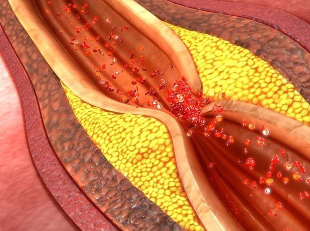 What happens in the arteries before a stroke