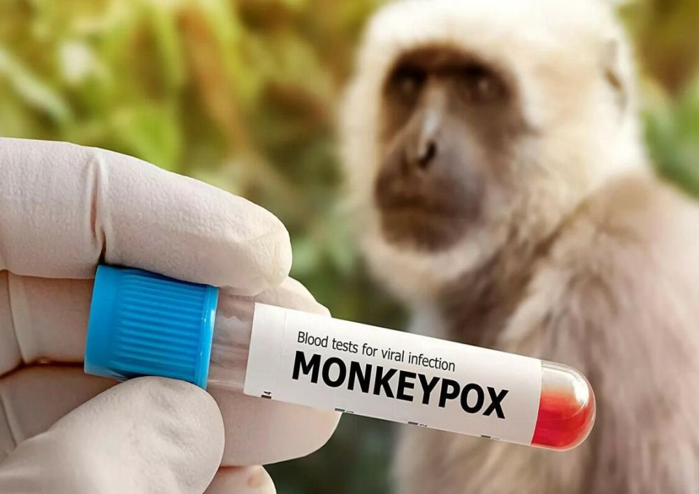 Where you can get monkeypox