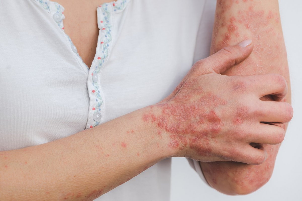 Psoriasis: the doctor named the best products to relieve the condition