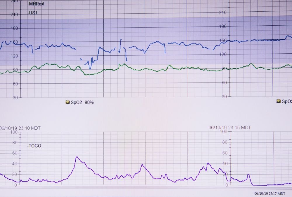 The risk of senile dementia can be identified by the cardiogram