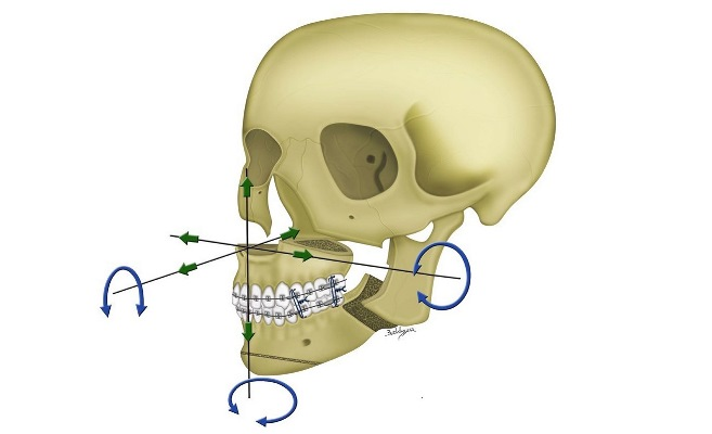 Woman develops rare eating disorder after jaw surgery