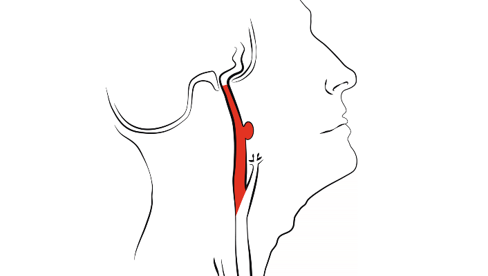 Tooth abscess causes rare carotid aneurysm arteries