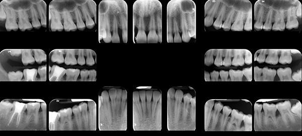 Hereditary manifestation of ankyloglossia and localized periodontitis2