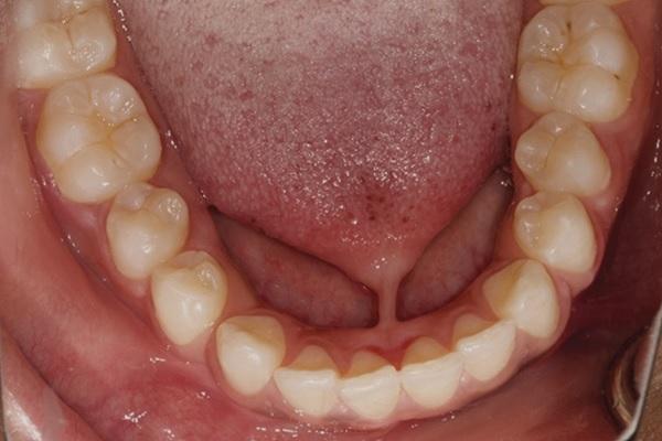 Hereditary manifestation of ankyloglossia and localized periodontitis