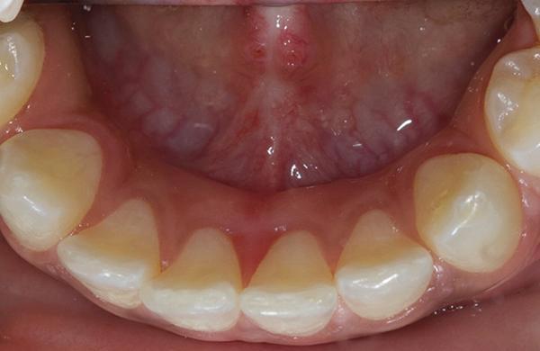 Hereditary manifestation of ankyloglossia and localized periodontitis5