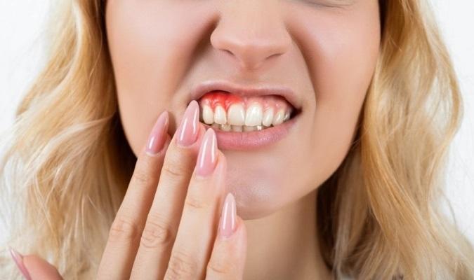 New topical gel may suppress gingival inflammation 