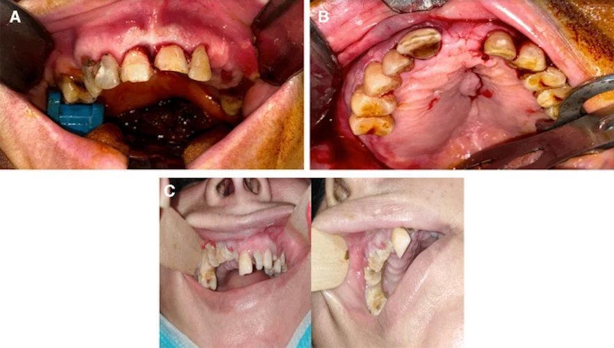 COVID-19 survivors are at risk osteonecrosis of the jaw2