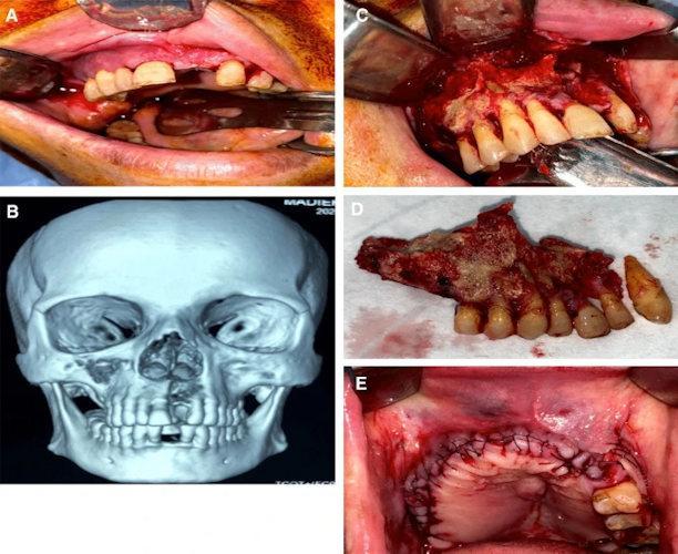 COVID-19 survivors are at risk of osteonecrosis of the jaw1