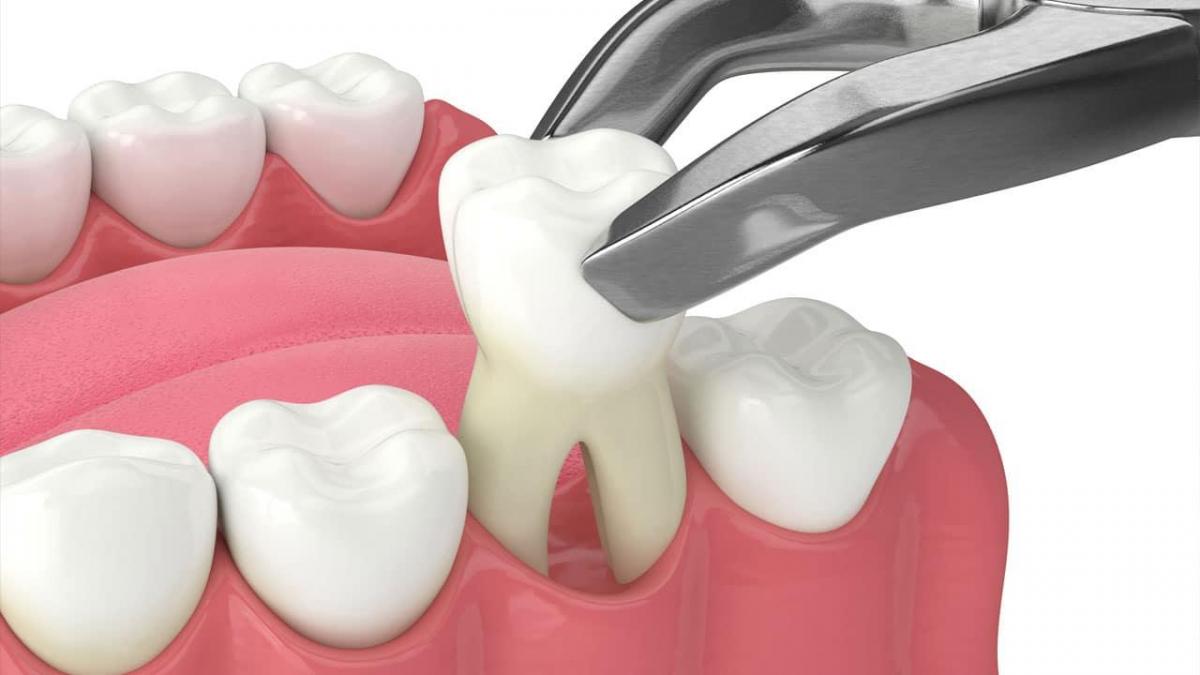 Prednisolone may cause a delay healing after tooth extraction