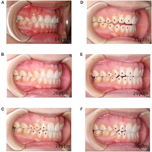 Neuroleptic drug caused open bite in 27-year-old women2