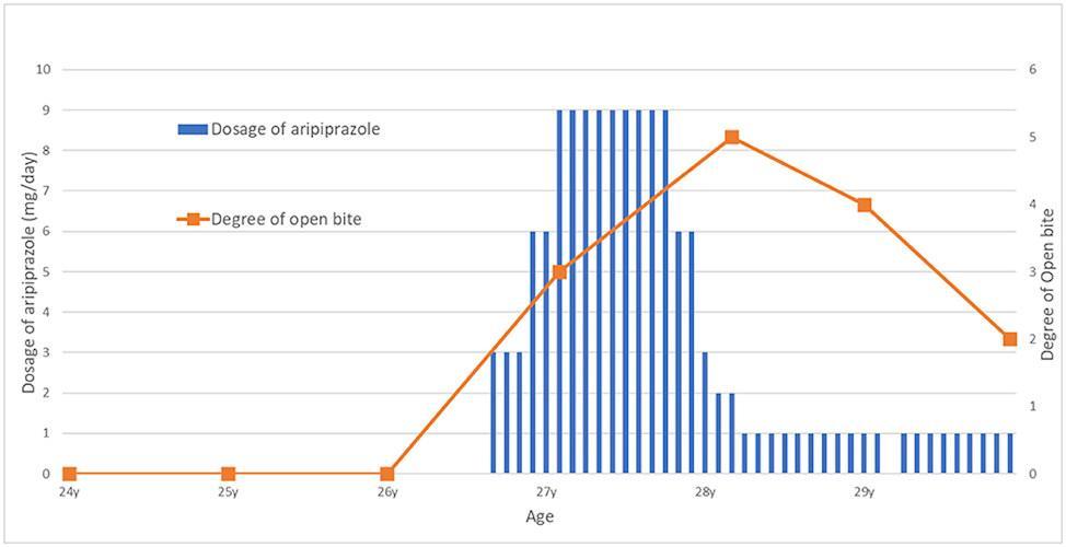 Neuroleptic became cause of open bite in a 27-year-old woman3