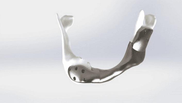  First 3D-printed titanium jaw fitted to cancer patient