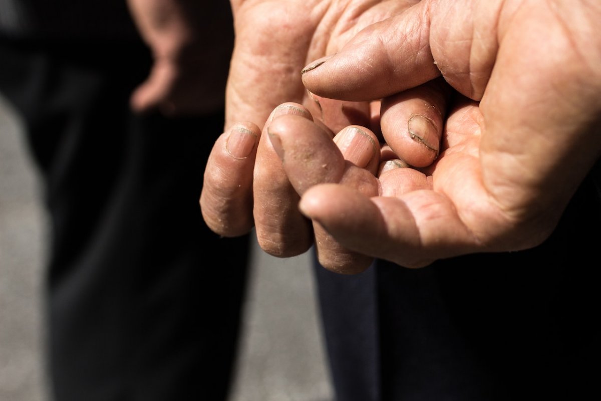 Doctors notice one sign on the fingers of patients with liver damage