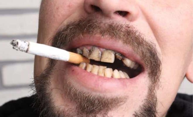 Effect of smoking on the treatment of periodontitis