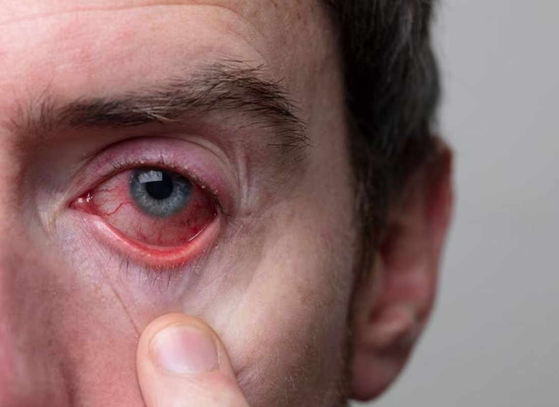 conjunctivitis