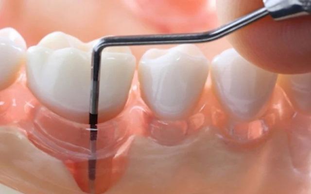 Ethnicity affects the effectiveness of periodontitis treatment