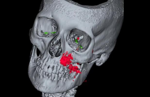 Dental procedure provoked pneumocephalus in a woman0