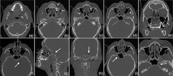 Dental procedure provoked pneumocephalus in a woman1