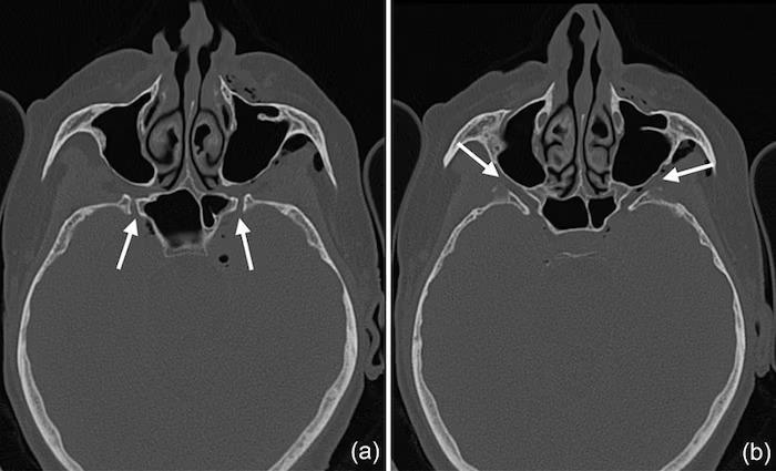 A dental procedure provoked pneumocephalus in a woman2