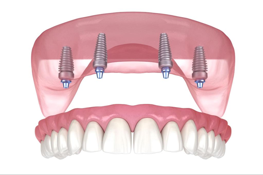 Teeth in 1 day or classic implantation? Which option to choose?