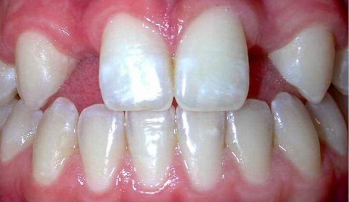 Researchers are studying relationship between dental agenesis and atopic dermatitis