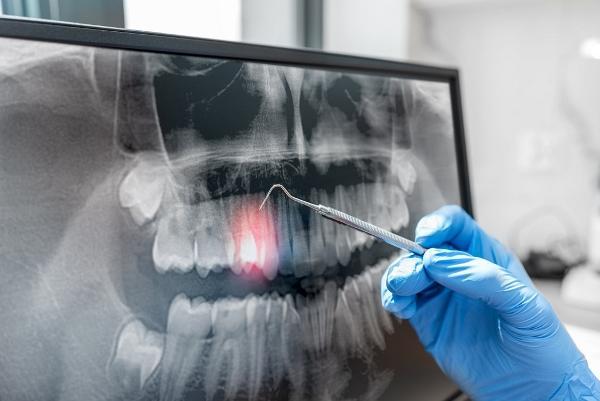 To detect caries, British researchers will develop artificial intelligence