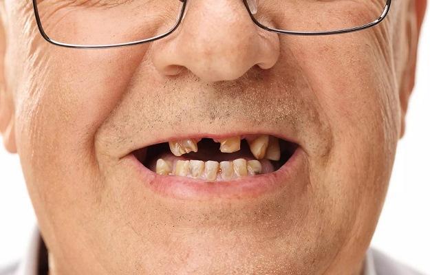 Tooth loss increases the risk deaths in older people