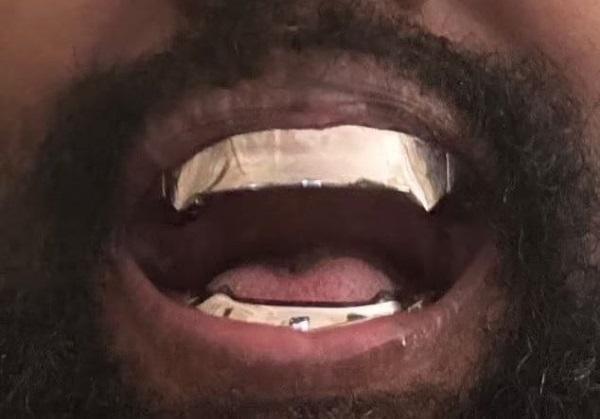 Rapper Ye performs a shocking teeth transformation