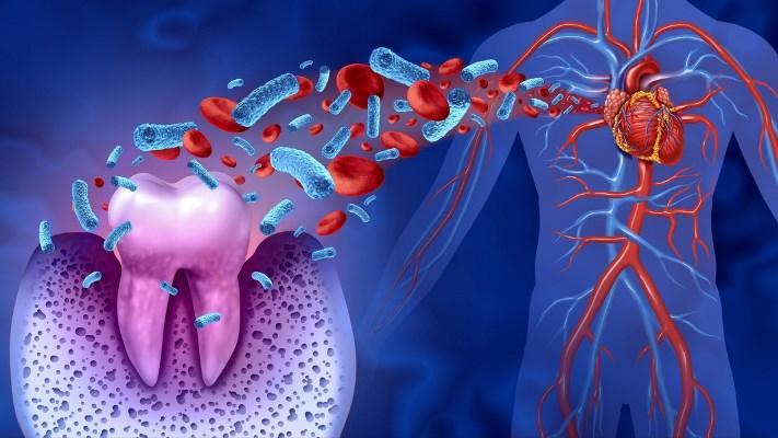 Common oral pathogen found to increase adverse effects of heart attack