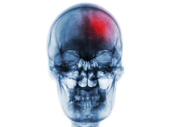 After tooth extraction it is possible development of endocarditis and stroke