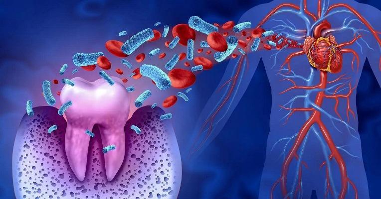 Treatment of periodontal diseases reduces probability of recurrence of atrial fibrillation