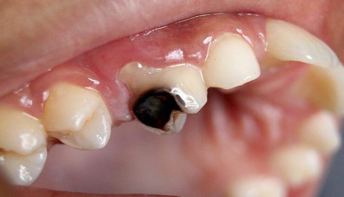 Inexpensive liquid to reduce tooth sensitivity fights caries