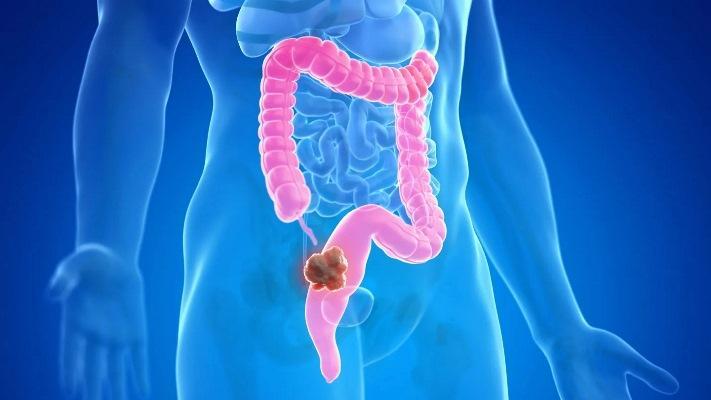 Oral bacteria linked to worsening colorectal cancer